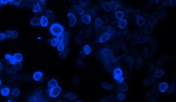Komórki nowotworu jelita grubego pod mikroskopem